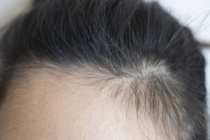 【女性の薄毛の原因】誤ったヘアケアによる批糠（ひこう）性脱毛症