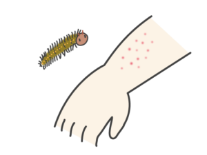 【虫刺されの対処】毛虫の毛は直接毛虫と接触していなくても虫刺されの症状が表れる！
