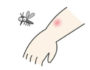 【虫刺されの痕】蚊（か）に刺された時の正しい処置方法