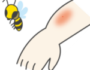 【虫刺されの痕】蜂（ハチ）に刺された時の正しい処置方法