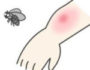 【虫刺されの痕】ブヨに刺された時の正しい処置方法