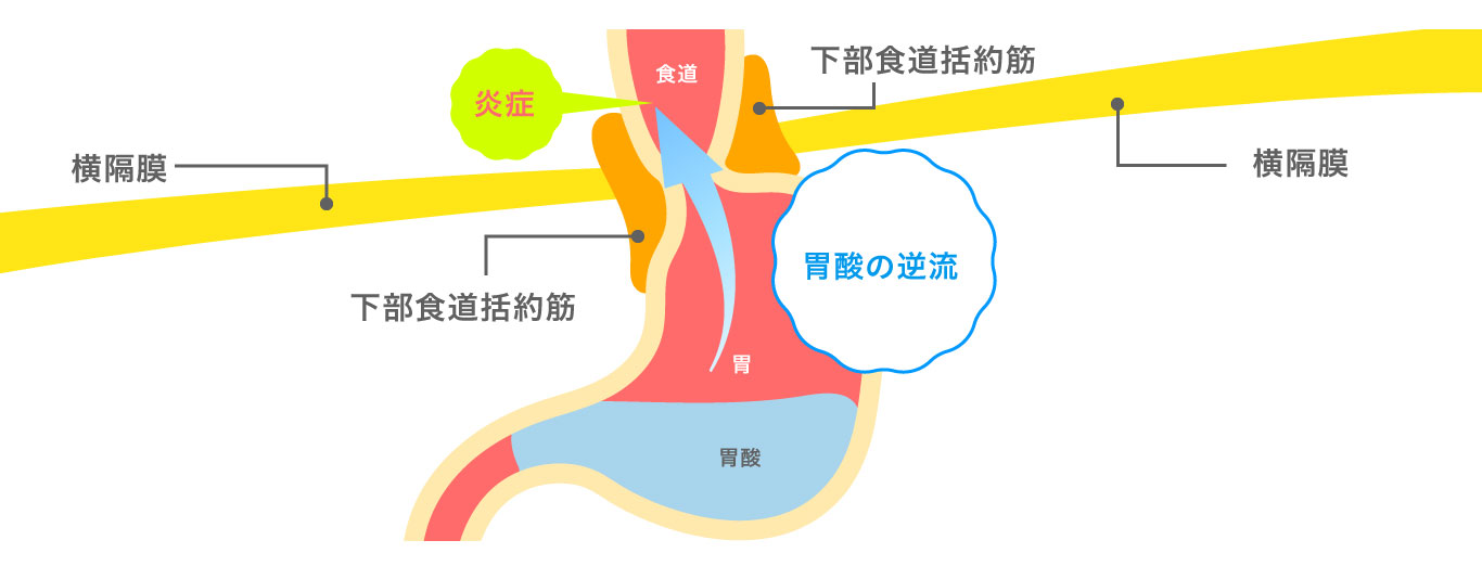 逆流性食道炎による胸やけは胃酸の逆流が原因です！