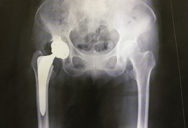 【股関節が痛い】変形性股関節症の治療方法「人工関節置換術」