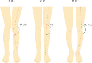 X脚 O脚を本気で矯正したい人向け 美脚 脚長を手に入れるストレッチの方法 株式会社テイコク製薬社